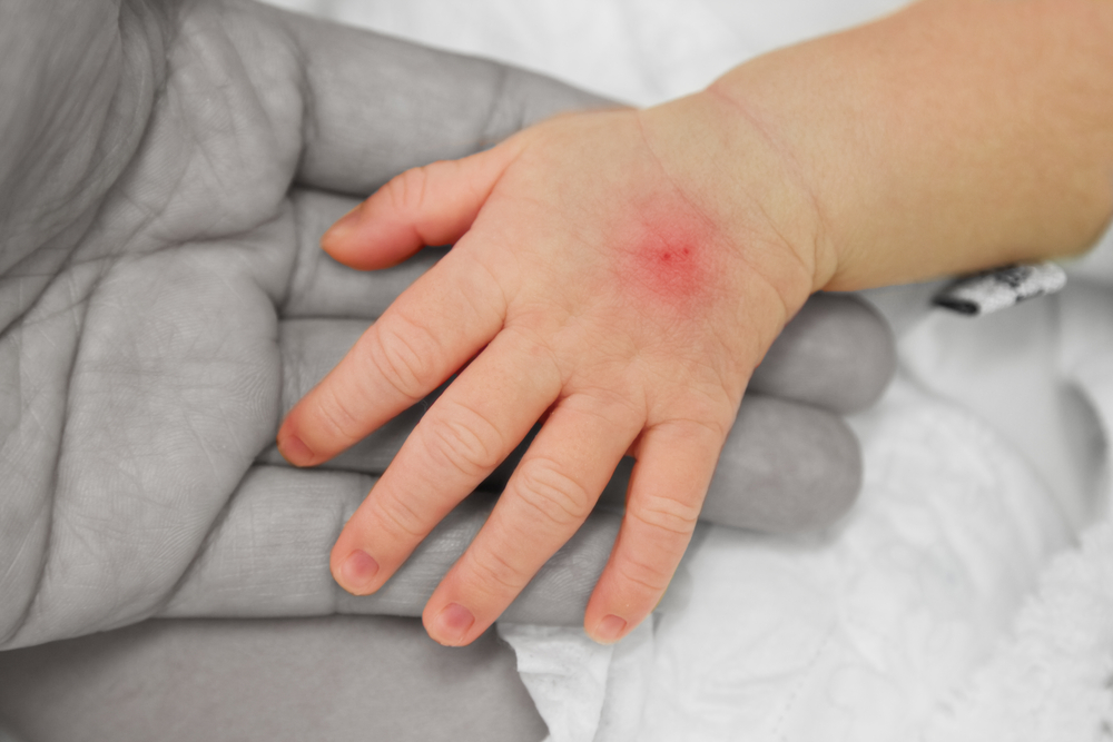 小孩被蚊子咬腫一大包還發紅！血管性水腫&蜂窩性組織炎該怎麼分？