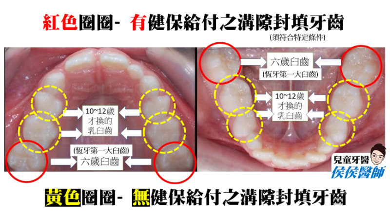 您家孩子 填 了嗎 牙齒 溝隙封填 十問十答 兒童牙醫侯侯醫師 媽咪拜mamibuy